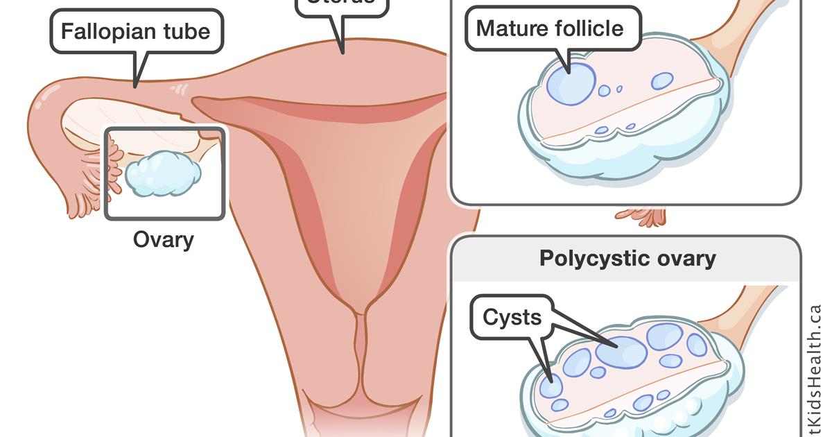 polycystic_ovaries_syndrome_MED_ILL_EN