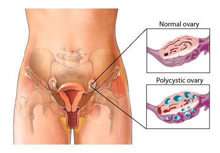 Polycystic-Ovarian-Syndrome