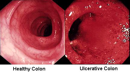 Image result for ulcerative colitis images
