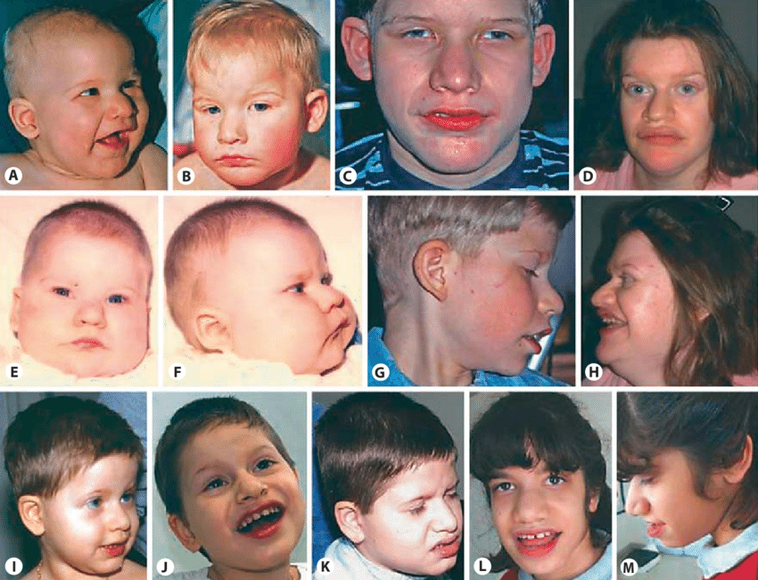 نتیجه تصویری برای pitt-hopkins syndrome
