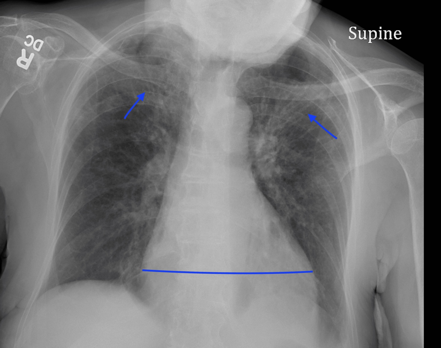 X-ray of a person's chest

Description automatically generated with low confidence