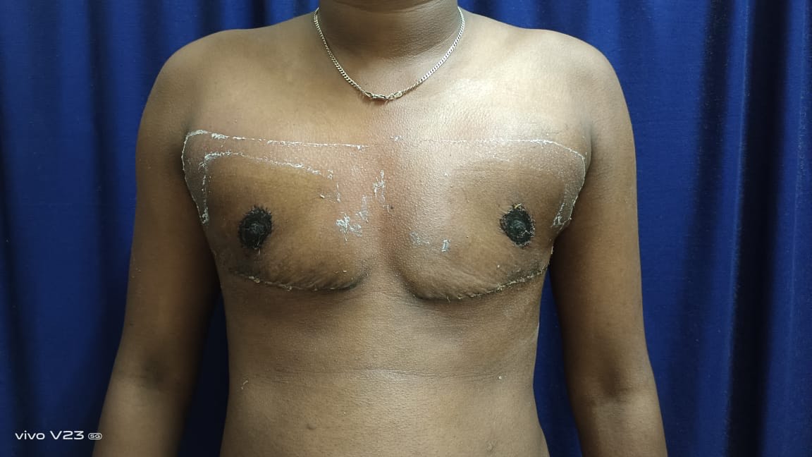 A person with a chest and chest marks

Description automatically generated with medium confidence