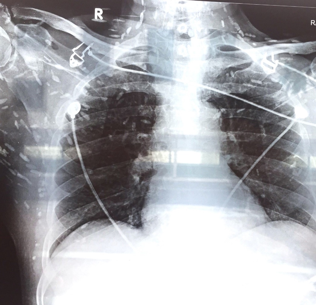 X-ray of a person's chest

Description automatically generated