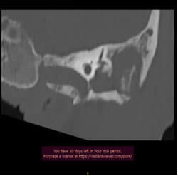 A close-up of a radiograph

Description automatically generated