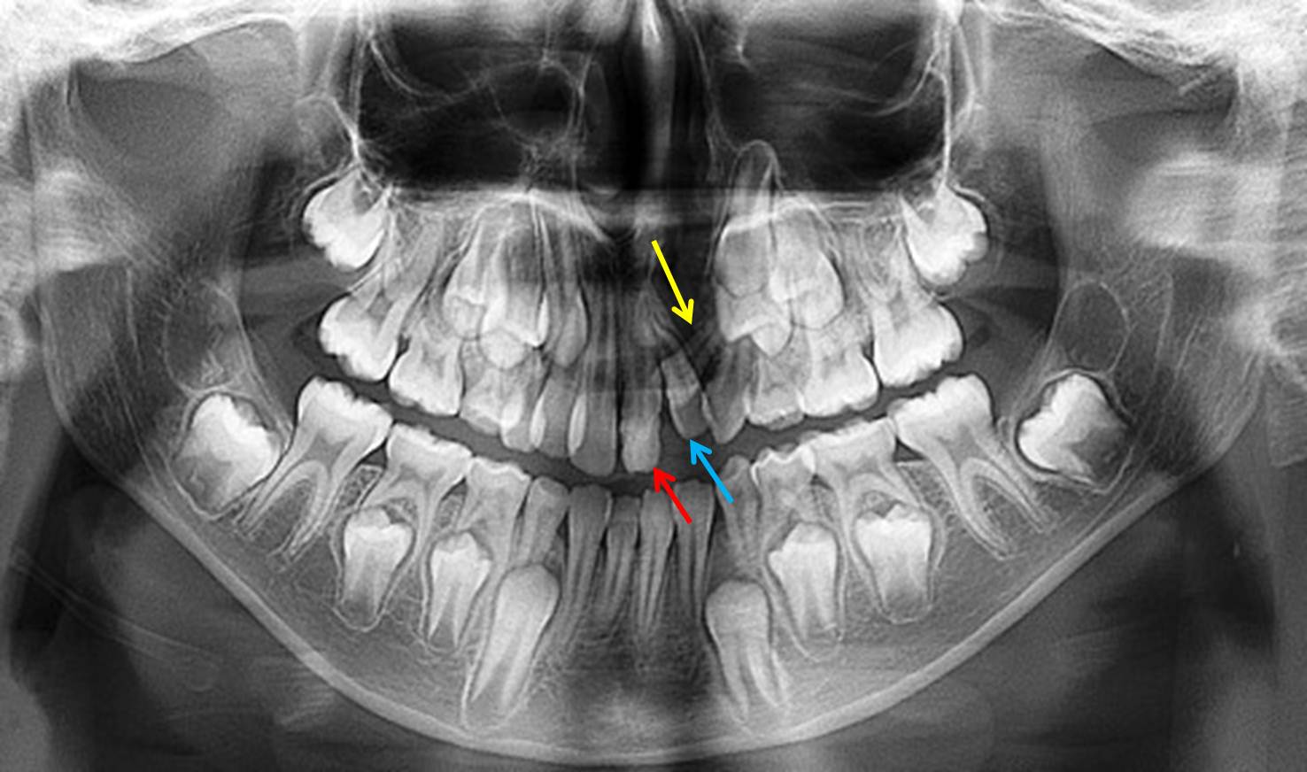 A x-ray of teeth and teeth

Description automatically generated