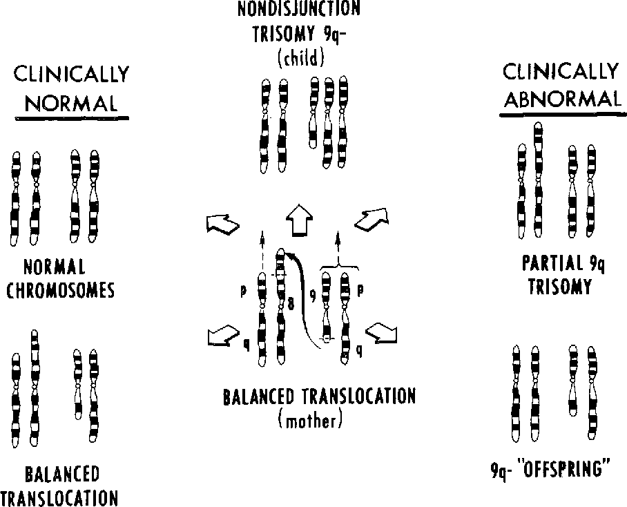 Trisomy 9q—. A variant of the 9p trisomy syndrome | Semantic Scholar