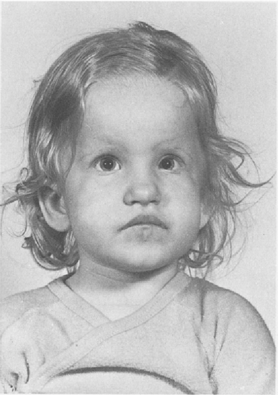Figure 1 from Trisomy 9p with i(9p) and t(9q18p) | Semantic Scholar