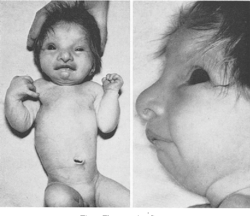 Partial and complete trisomy 9: Delineation of a trisomy 9 syndrome |  Semantic Scholar
