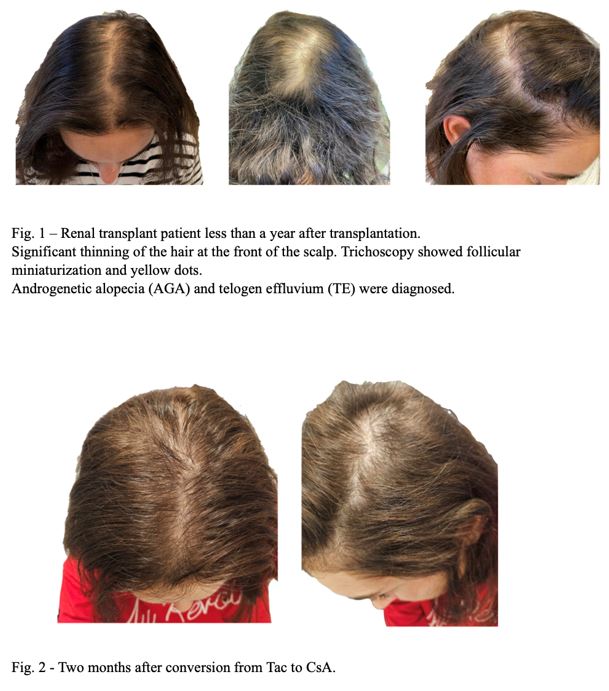 A collage of hair loss treatment

AI-generated content may be incorrect.