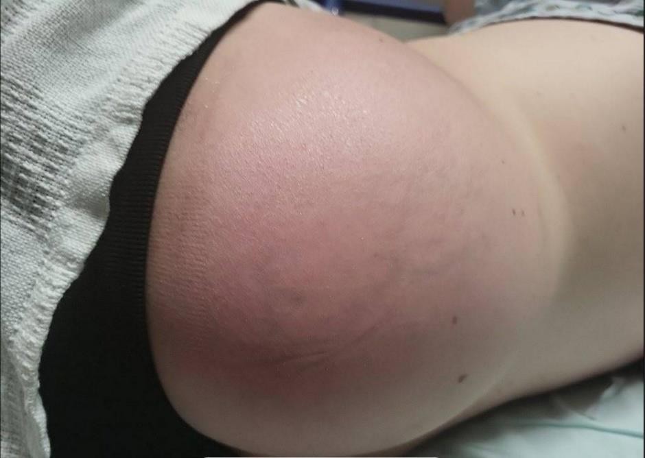 A close up of a person's buttocks  Description automatically generated