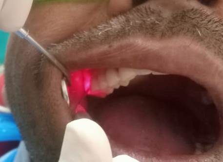A person getting dental check up

AI-generated content may be incorrect.