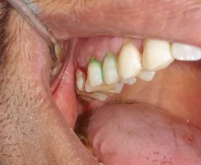 Close-up of a person's mouth with a dental tool

AI-generated content may be incorrect.