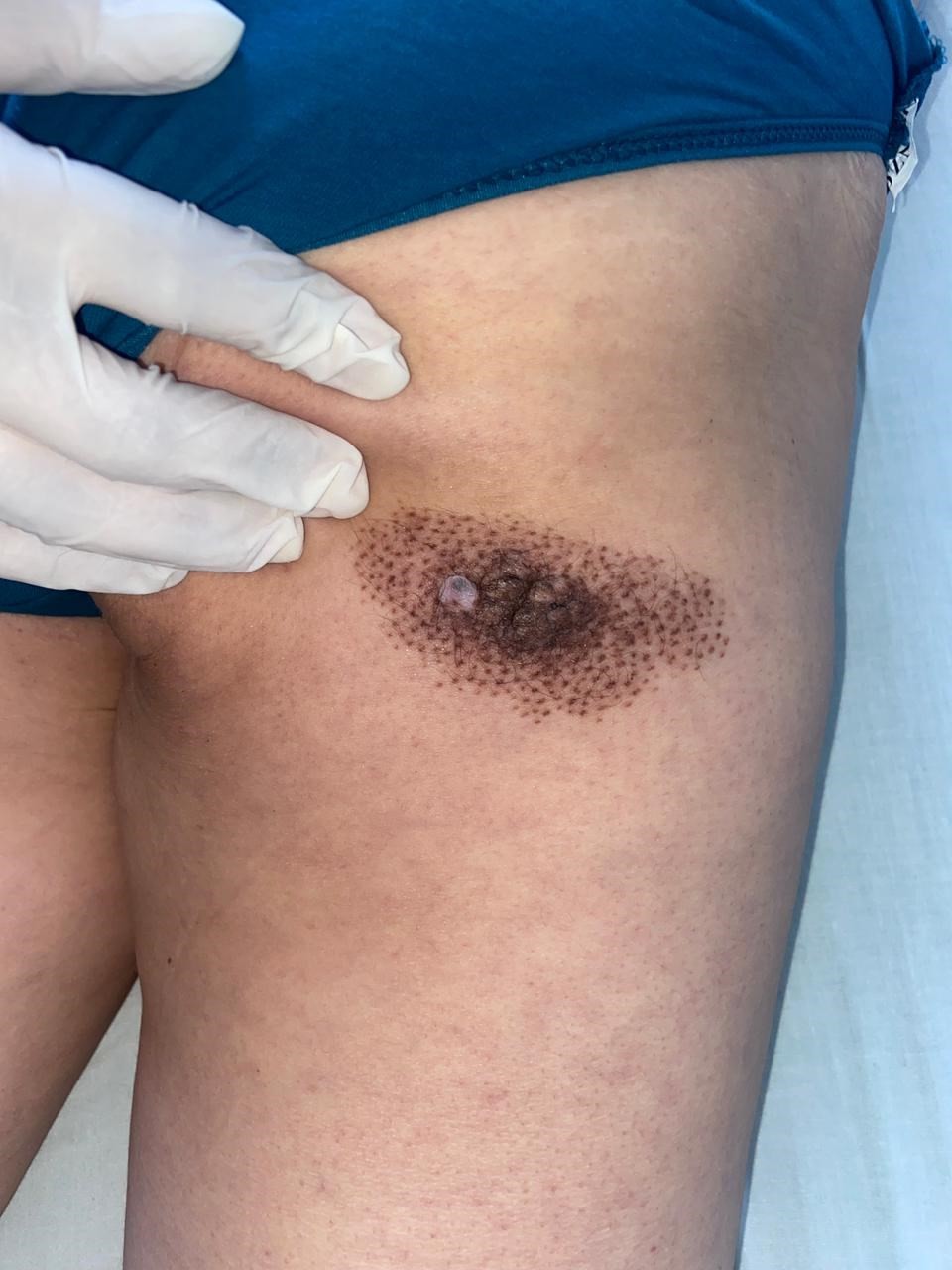 A close-up of a skin injury

AI-generated content may be incorrect.